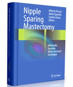 Nipple Sparing Mastectomy: Minimally Invasive Video-Assisted Technique