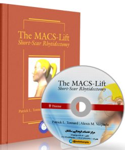 The MACS-Lift: Short-Scar Rhytidectomy