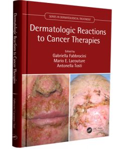 Dermatologic Reactions to Cancer Therapies (Series in Dermatological Treatment)