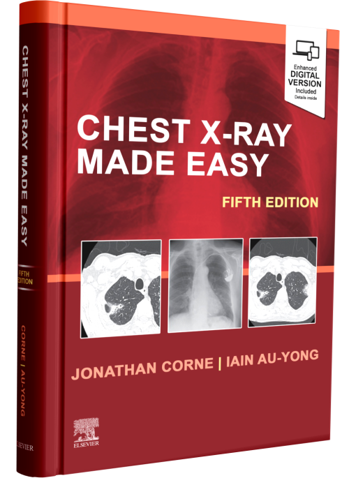 Chest X Ray Made Easy 5th Edition vrogue.co