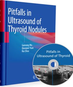Pitfalls in Ultrasound of Thyroid Nodules