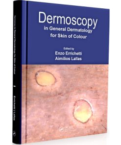 Dermoscopy in General Dermatology for Skin of Color