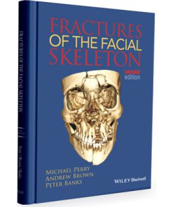 Fractures of the facial skeleton