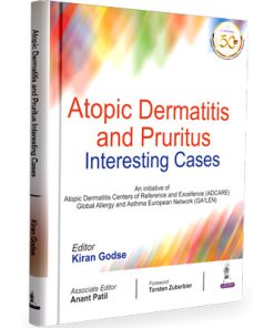 Atopic Dermatitis And Pruritus Interesting Cases